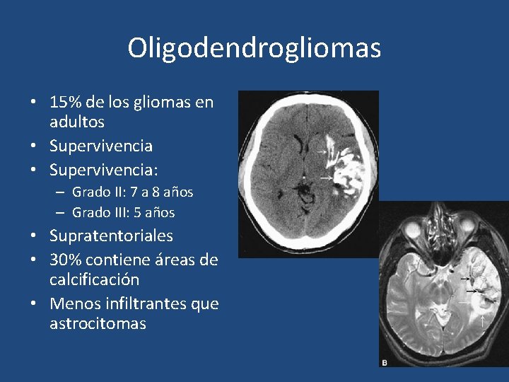 Oligodendrogliomas • 15% de los gliomas en adultos • Supervivencia: – Grado II: 7