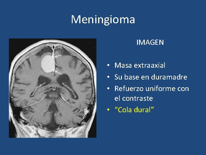 Meningioma IMAGEN • Masa extraaxial • Su base en duramadre • Refuerzo uniforme con