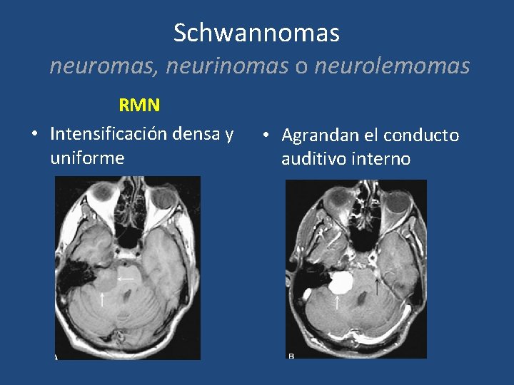 Schwannomas neuromas, neurinomas o neurolemomas RMN • Intensificación densa y uniforme • Agrandan el