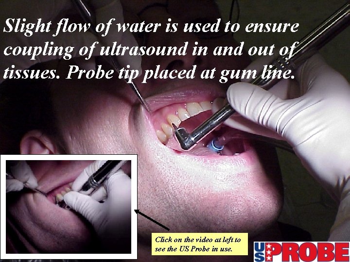 Slight flow of water is used to ensure coupling of ultrasound in and out