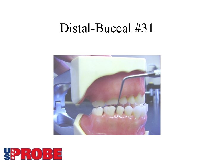Distal-Buccal #31 