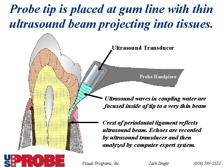 Probe tip is placed at gum line with thin ultrasound beam projecting into tissues.