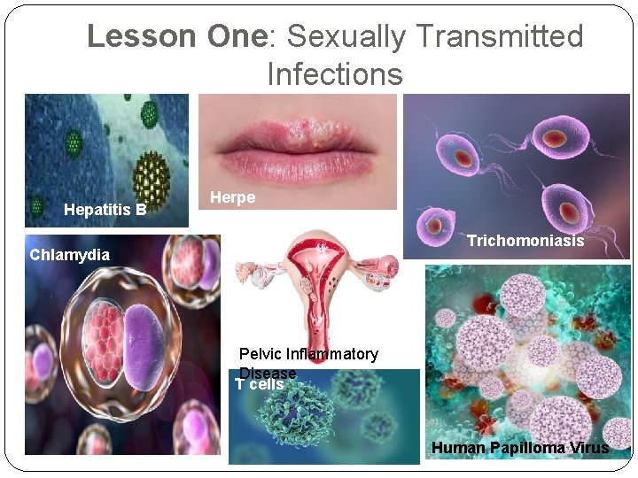 Lesson One: Sexually Transmitted Infections Hepatitis B Herpe s Trichomoniasis Chlamydia Pelvic Inflammatory Disease