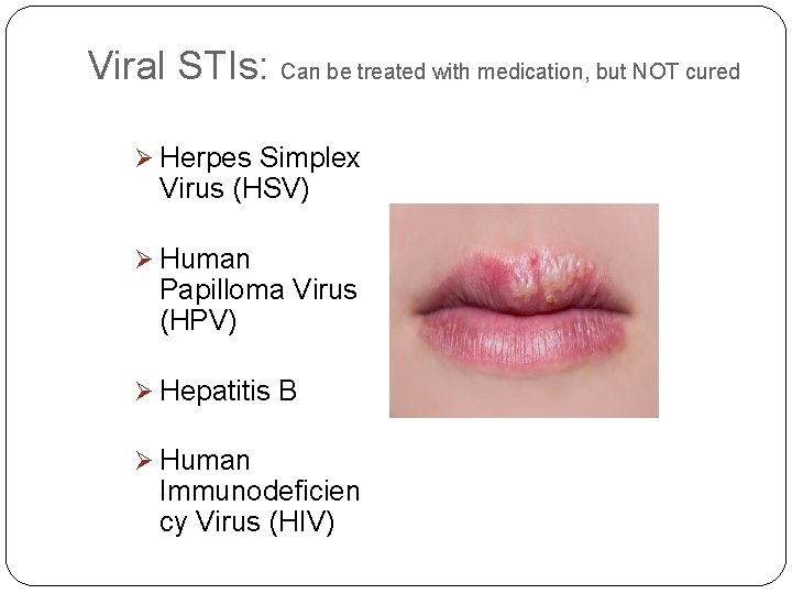 Viral STIs: Can be treated with medication, but NOT cured Ø Herpes Simplex Virus