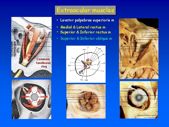 Extraocular muscles • Levator palpebrae superioris m. • Medial & Lateral rectus m. •