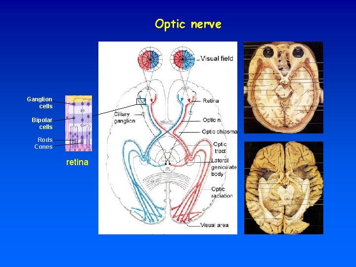 Optic nerve Ganglion cells Bipolar cells Rods Cones retina 