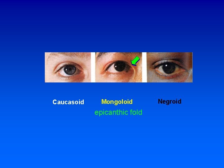 Caucasoid Mongoloid epicanthic fold Negroid 