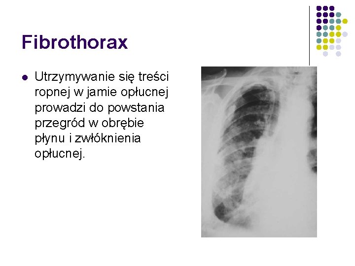 Fibrothorax l Utrzymywanie się treści ropnej w jamie opłucnej prowadzi do powstania przegród w