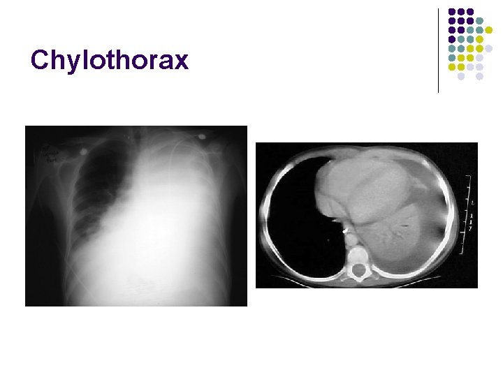 Chylothorax 