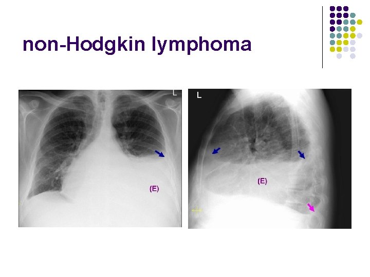 non-Hodgkin lymphoma 