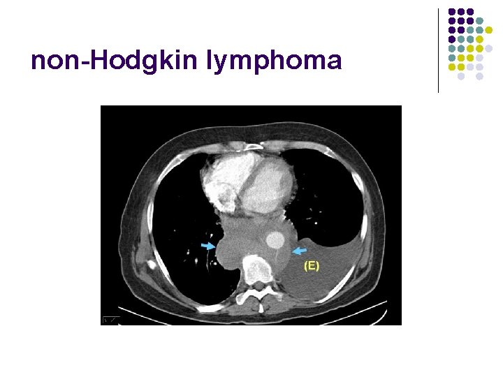 non-Hodgkin lymphoma 