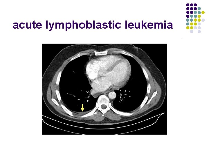 acute lymphoblastic leukemia 