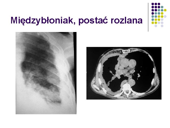 Międzybłoniak, postać rozlana 