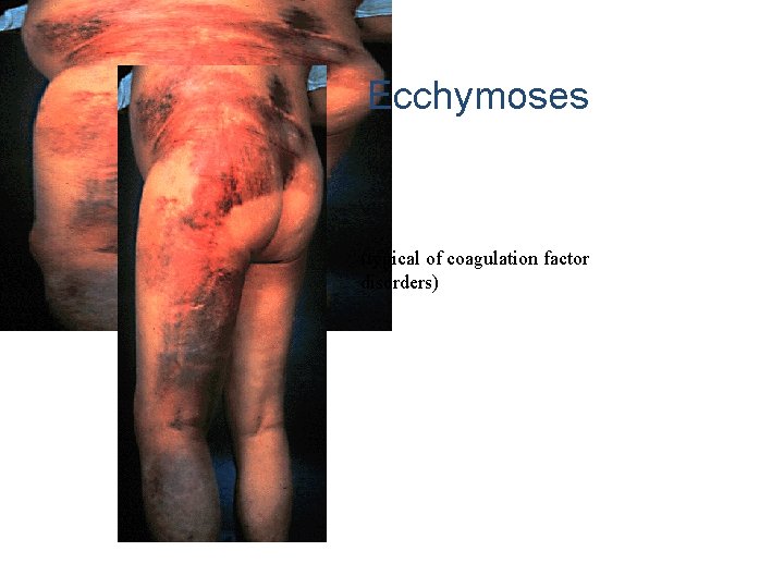 Ecchymoses (typical of coagulation factor disorders) 