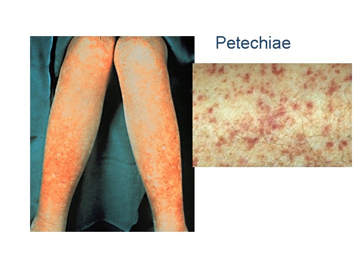 Petechiae 