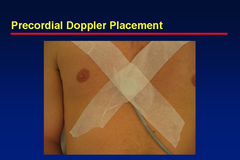 Precordial Doppler Placement 