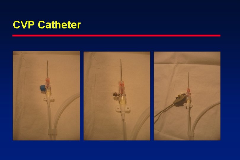 CVP Catheter 