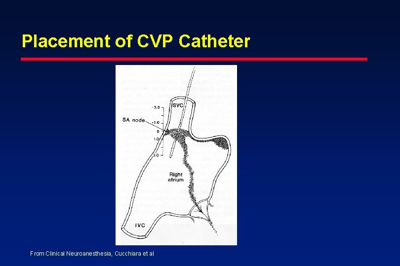 Placement of CVP Catheter From Clinical Neuroanesthesia, Cucchiara et al 