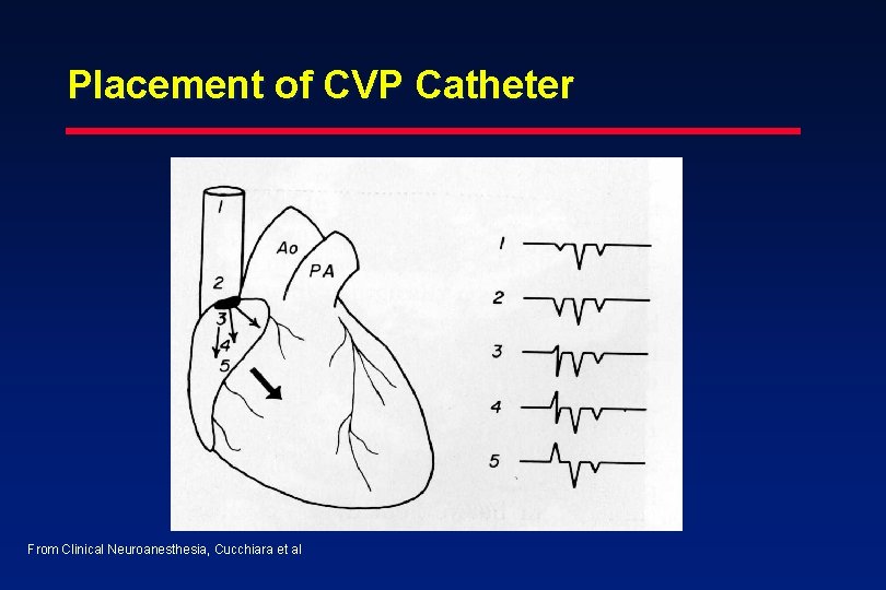 Placement of CVP Catheter From Clinical Neuroanesthesia, Cucchiara et al 