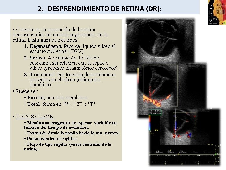 2. - DESPRENDIMIENTO DE RETINA (DR): • Consiste en la separación de la retina
