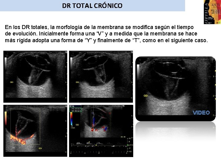 DR TOTAL CRÓNICO En los DR totales, la morfología de la membrana se modifica