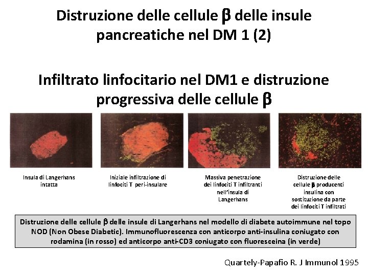 Distruzione delle cellule b delle insule pancreatiche nel DM 1 (2) Infiltrato linfocitario nel