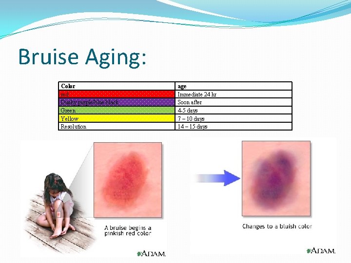 Bruise Aging: Color red Dusky purple/blue black Green Yellow Resolution age Immediate 24 hr