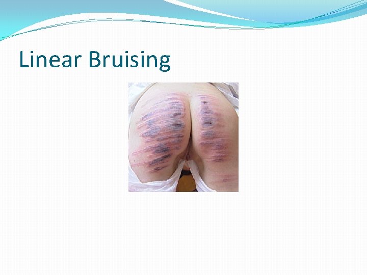 Linear Bruising 