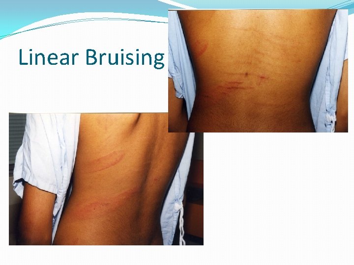 Linear Bruising 