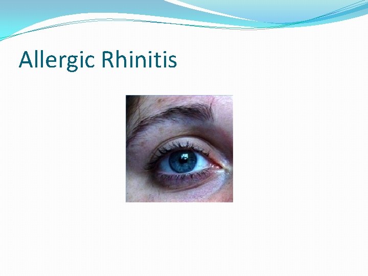 Allergic Rhinitis 
