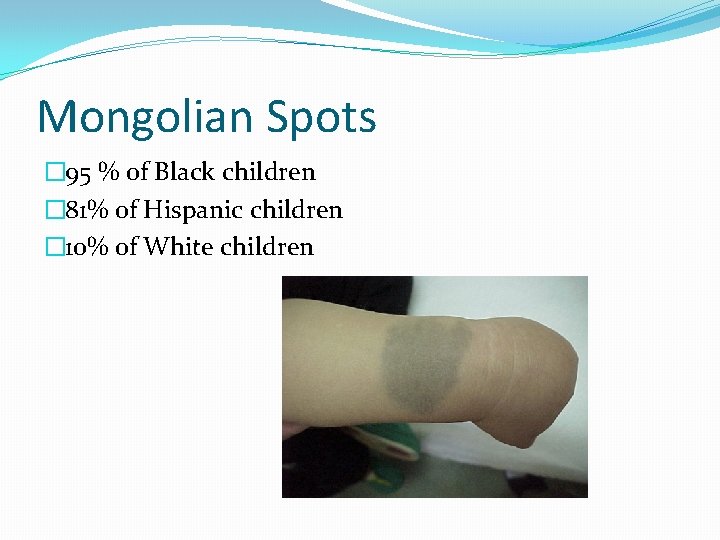 Mongolian Spots � 95 % of Black children � 81% of Hispanic children �