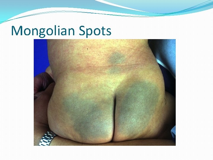 Mongolian Spots 