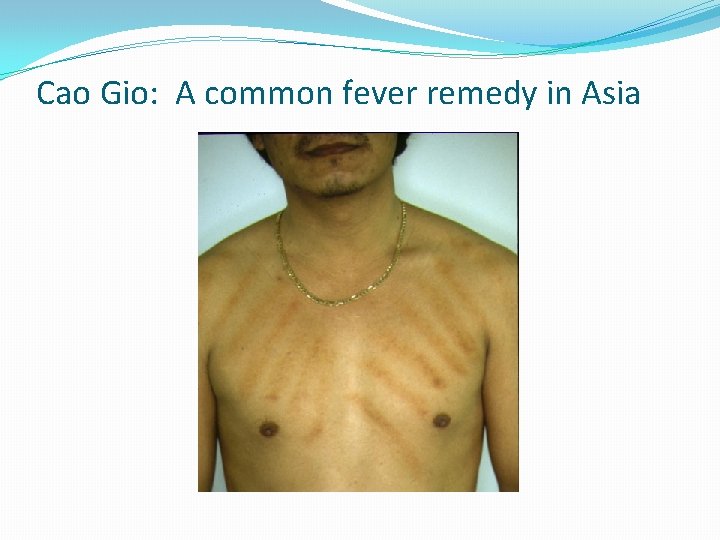 Cao Gio: A common fever remedy in Asia 