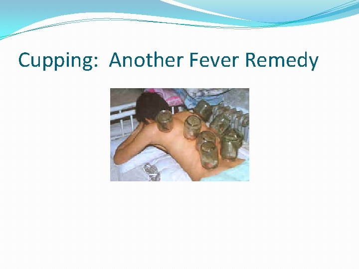 Cupping: Another Fever Remedy 