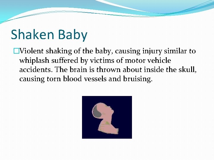 Shaken Baby �Violent shaking of the baby, causing injury similar to whiplash suffered by