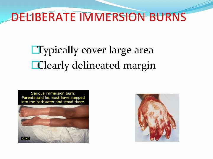 DELIBERATE IMMERSION BURNS �Typically cover large area �Clearly delineated margin 