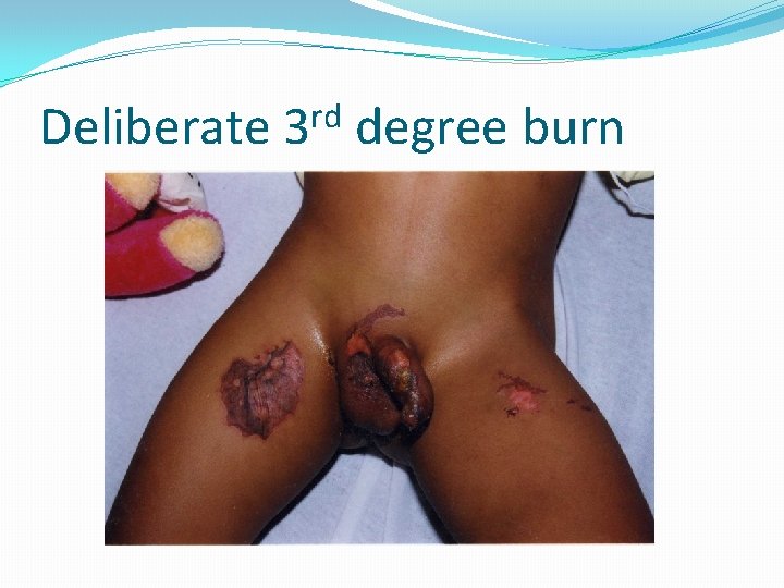 Deliberate rd 3 degree burn 