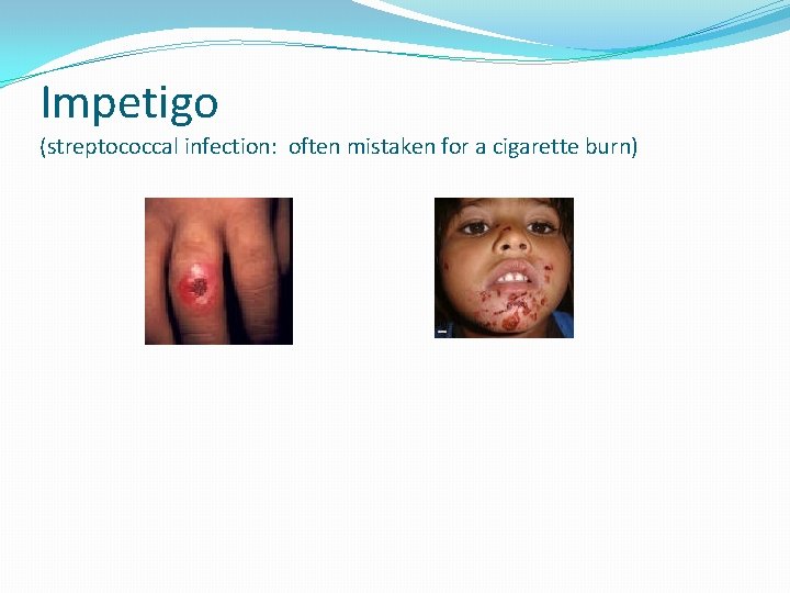 Impetigo (streptococcal infection: often mistaken for a cigarette burn) 