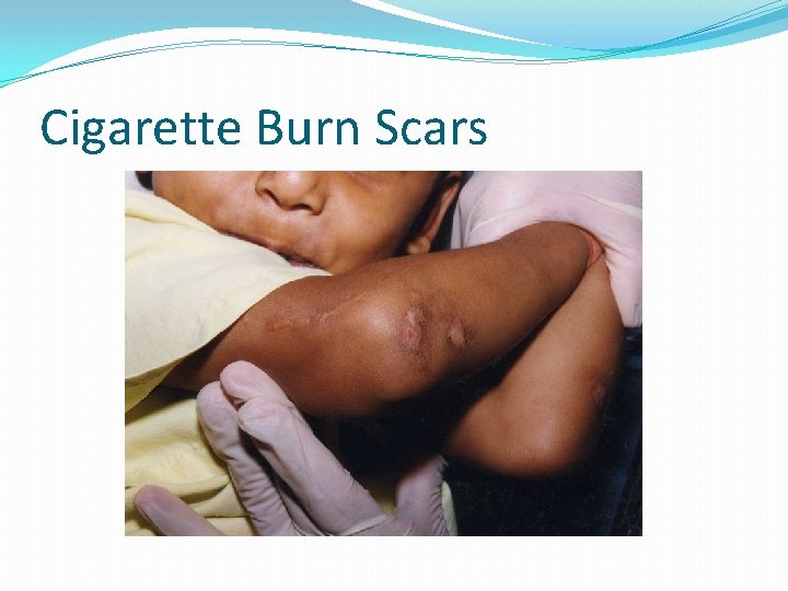 Cigarette Burn Scars 