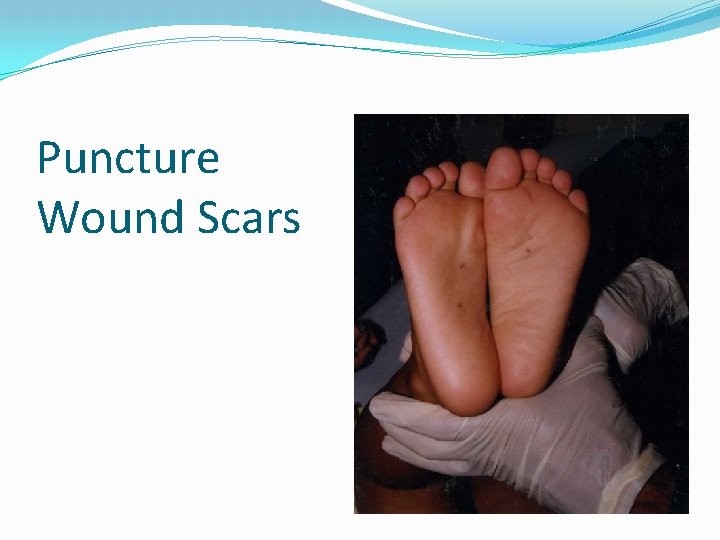 Puncture Wound Scars 