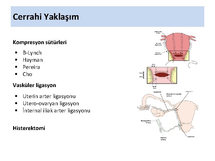 Cerrahi Yaklaşım Kompresyon sütürleri § § B-Lynch Hayman Pereira Cho Vasküler ligasyon § Uterin