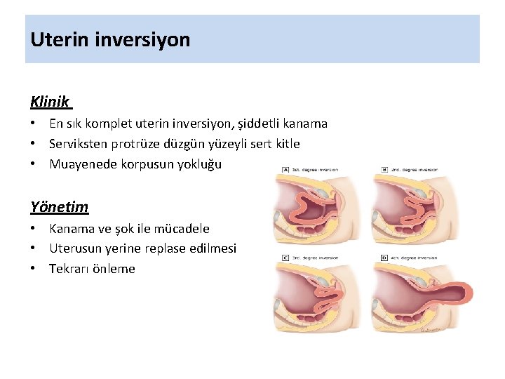 Uterin inversiyon Klinik • En sık komplet uterin inversiyon, şiddetli kanama • Serviksten protrüze