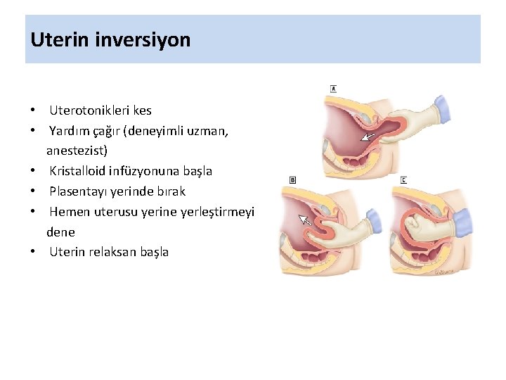 Uterin inversiyon • Uterotonikleri kes • Yardım çağır (deneyimli uzman, anestezist) • Kristalloid infüzyonuna