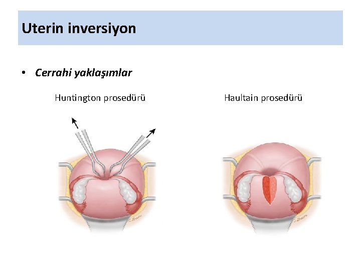 Uterin inversiyon • Cerrahi yaklaşımlar Huntington prosedürü Haultain prosedürü 