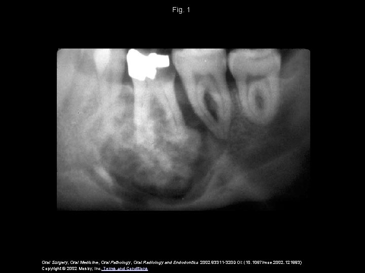 Fig. 1 Oral Surgery, Oral Medicine, Oral Pathology, Oral Radiology and Endodontics 2002 93311 Fig. 1 Oral Surgery, Oral Medicine, Oral Pathology, Oral Radiology and Endodontics 2002 93311