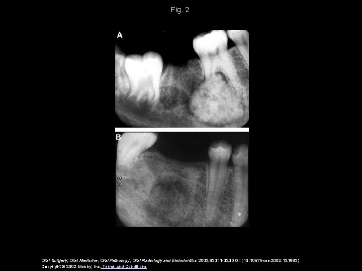 Fig. 2 Oral Surgery, Oral Medicine, Oral Pathology, Oral Radiology and Endodontics 2002 93311 Fig. 2 Oral Surgery, Oral Medicine, Oral Pathology, Oral Radiology and Endodontics 2002 93311