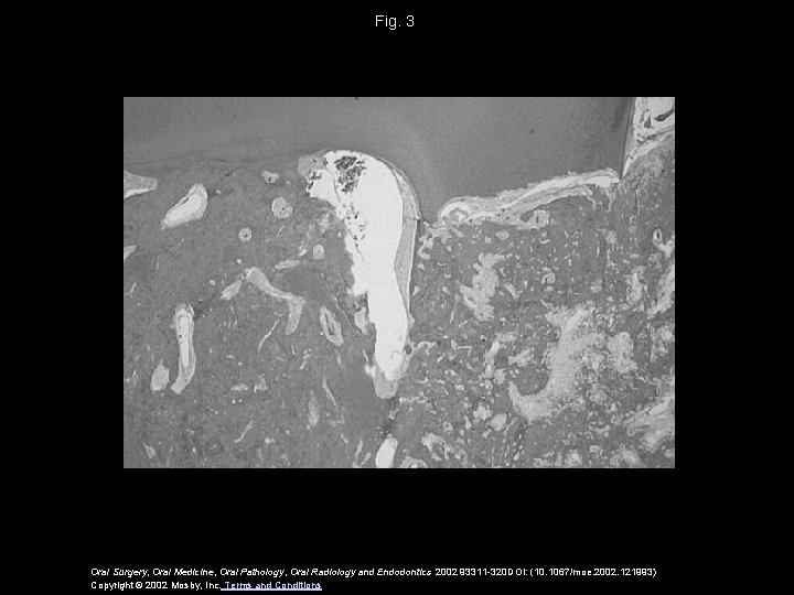 Fig. 3 Oral Surgery, Oral Medicine, Oral Pathology, Oral Radiology and Endodontics 2002 93311 Fig. 3 Oral Surgery, Oral Medicine, Oral Pathology, Oral Radiology and Endodontics 2002 93311