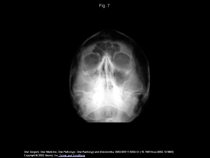 Fig. 7 Oral Surgery, Oral Medicine, Oral Pathology, Oral Radiology and Endodontics 2002 93311 Fig. 7 Oral Surgery, Oral Medicine, Oral Pathology, Oral Radiology and Endodontics 2002 93311
