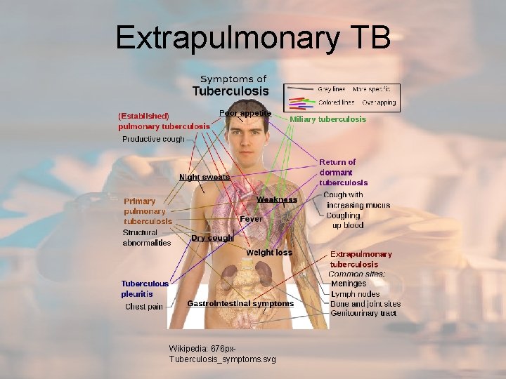 Extrapulmonary TB Wikipedia: 676 px. Tuberculosis_symptoms. svg 