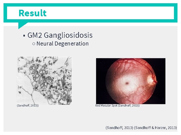 Result ■ GM 2 Gangliosidosis ○ Neural Degeneration (Sandhoff, 2013)) Red Macular Spot (Sandhoff,